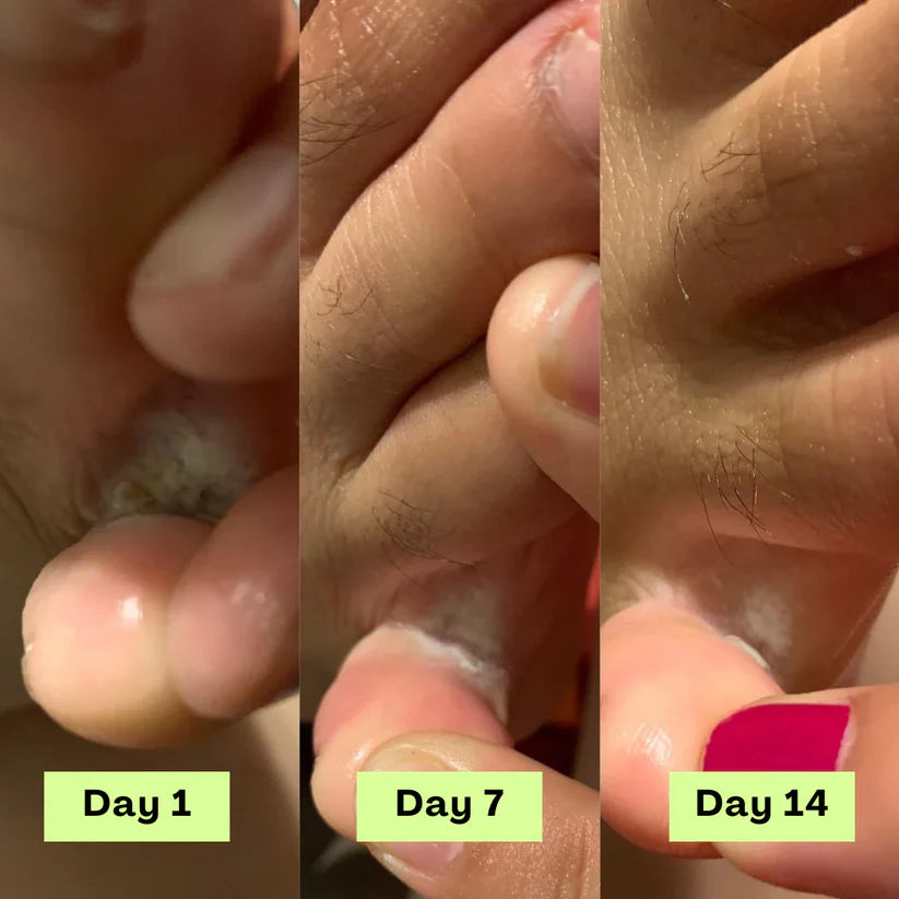 Stayfoll® AntiFungal Relief Soap Bar