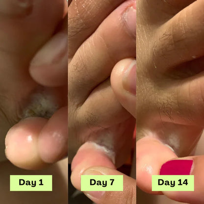 Stayfoll® AntiFungal Relief Soap Bar